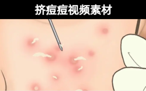 211款-挤痘痘解压实拍视频素材下载