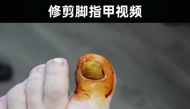 409款-修剪脚指甲视频解压大全